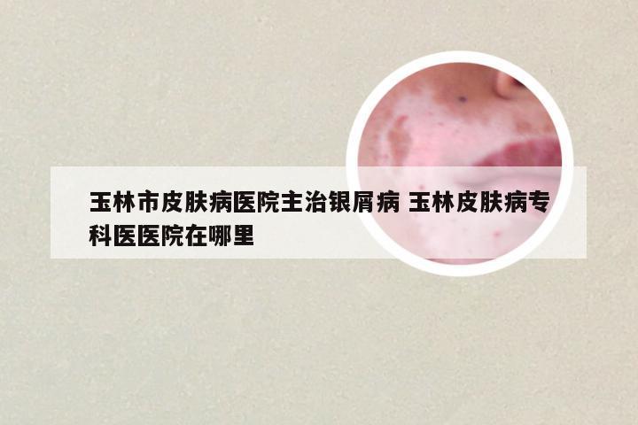 玉林市皮肤病医院主治银屑病 玉林皮肤病专科医医院在哪里