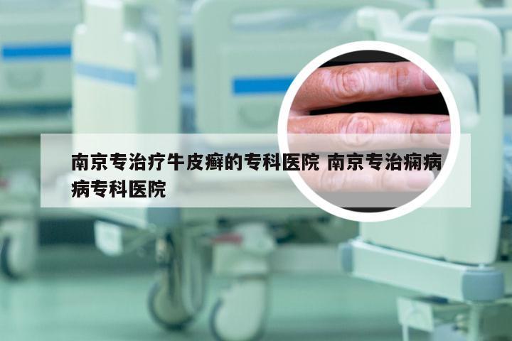 南京专治疗牛皮癣的专科医院 南京专治痫病病专科医院
