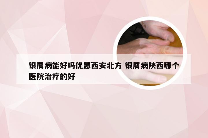 银屑病能好吗优惠西安北方 银屑病陕西哪个医院治疗的好