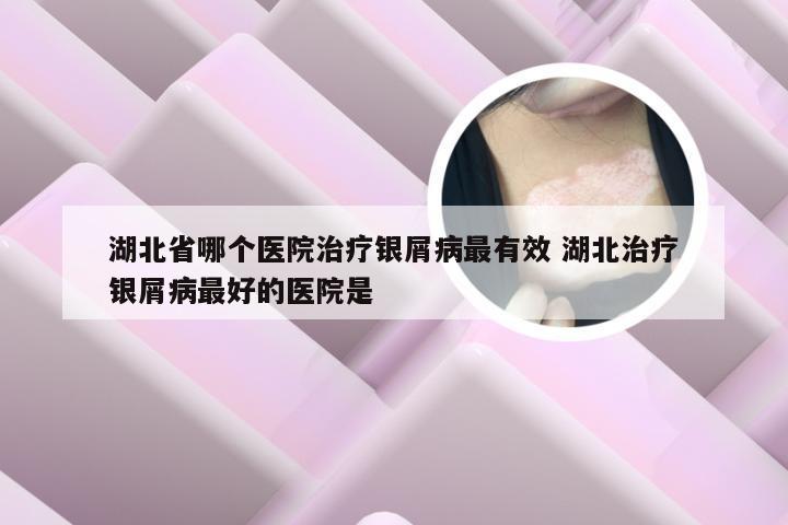 湖北省哪个医院治疗银屑病最有效 湖北治疗银屑病最好的医院是