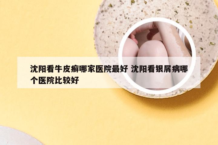 沈阳看牛皮癣哪家医院最好 沈阳看银屑病哪个医院比较好