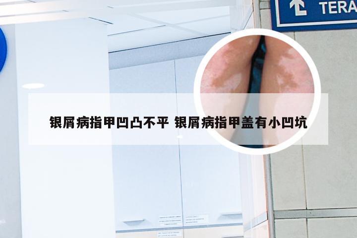 银屑病指甲凹凸不平 银屑病指甲盖有小凹坑