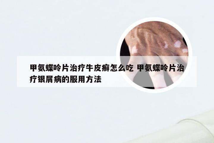 甲氨蝶呤片治疗牛皮癣怎么吃 甲氨蝶呤片治疗银屑病的服用方法