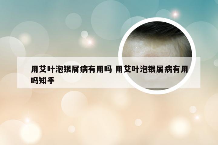 用艾叶泡银屑病有用吗 用艾叶泡银屑病有用吗知乎