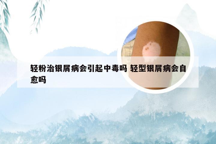 轻粉治银屑病会引起中毒吗 轻型银屑病会自愈吗