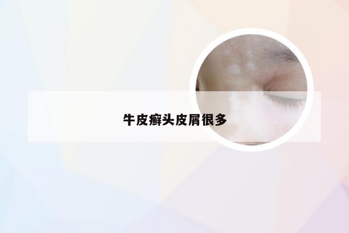 牛皮癣头皮屑很多