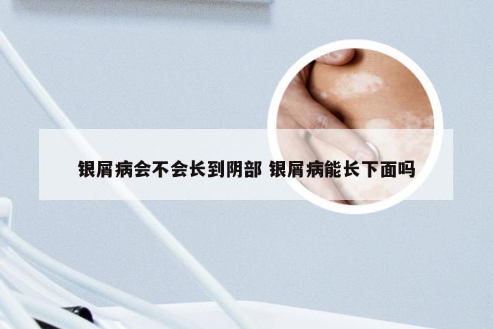 银屑病会不会长到阴部 银屑病能长下面吗