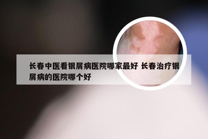 长春中医看银屑病医院哪家最好 长春治疗银屑病的医院哪个好