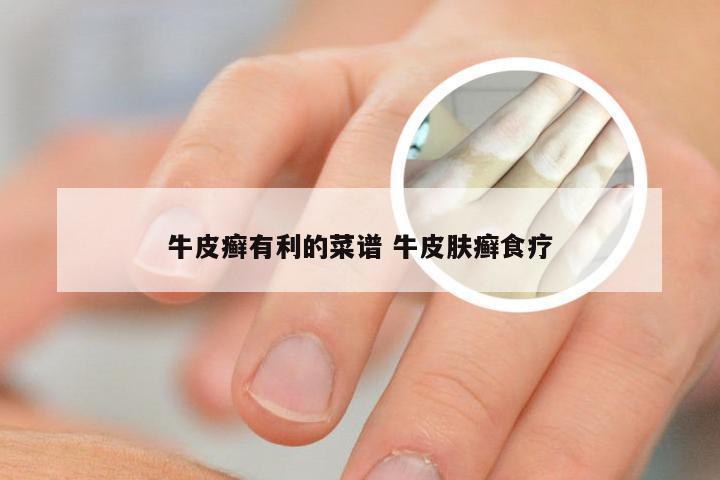 牛皮癣有利的菜谱 牛皮肤癣食疗