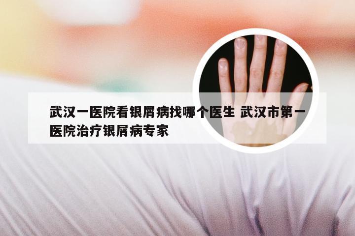 武汉一医院看银屑病找哪个医生 武汉市第一医院治疗银屑病专家