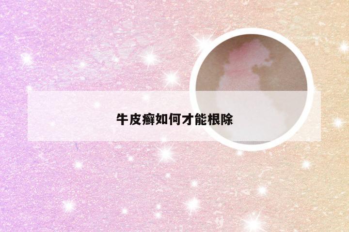 牛皮癣如何才能根除