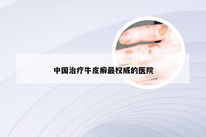 中国治疗牛皮癣最权威的医院