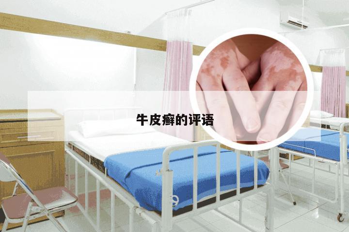 牛皮癣的评语