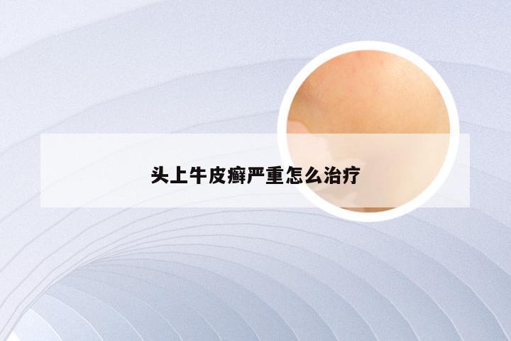 头上牛皮癣严重怎么治疗