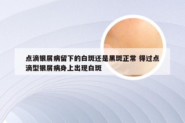 点滴银屑病留下的白斑还是黑斑正常 得过点滴型银屑病身上出现白斑