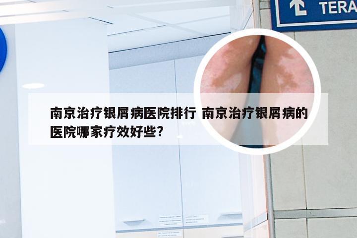 南京治疗银屑病医院排行 南京治疗银屑病的医院哪家疗效好些?