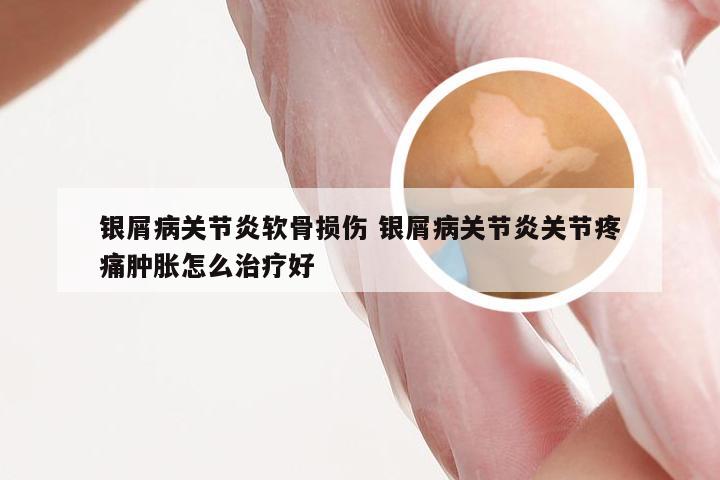 银屑病关节炎软骨损伤 银屑病关节炎关节疼痛肿胀怎么治疗好