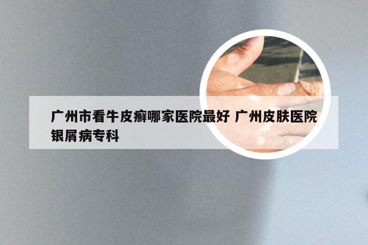 广州市看牛皮癣哪家医院最好 广州皮肤医院银屑病专科