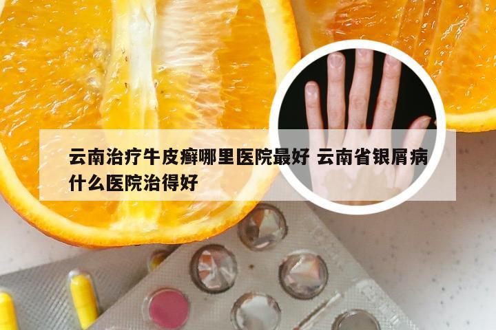 云南治疗牛皮癣哪里医院最好 云南省银屑病什么医院治得好