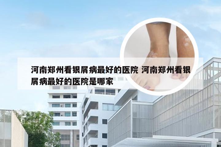 河南郑州看银屑病最好的医院 河南郑州看银屑病最好的医院是哪家