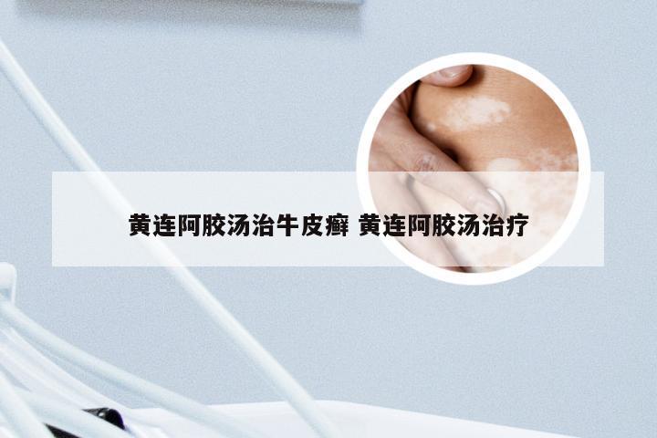 黄连阿胶汤治牛皮癣 黄连阿胶汤治疗