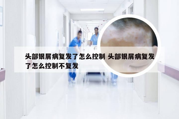 头部银屑病复发了怎么控制 头部银屑病复发了怎么控制不复发