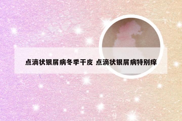 点滴状银屑病冬季干皮 点滴状银屑病特别痒