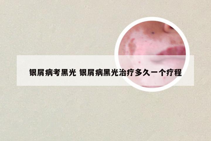 银屑病考黑光 银屑病黑光治疗多久一个疗程