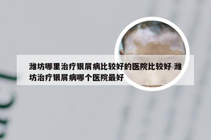 潍坊哪里治疗银屑病比较好的医院比较好 潍坊治疗银屑病哪个医院最好