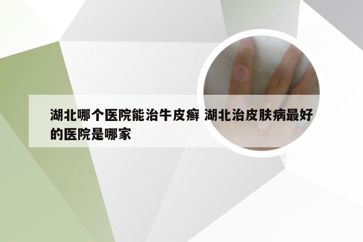 湖北哪个医院能治牛皮癣 湖北治皮肤病最好的医院是哪家