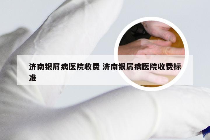 济南银屑病医院收费 济南银屑病医院收费标准