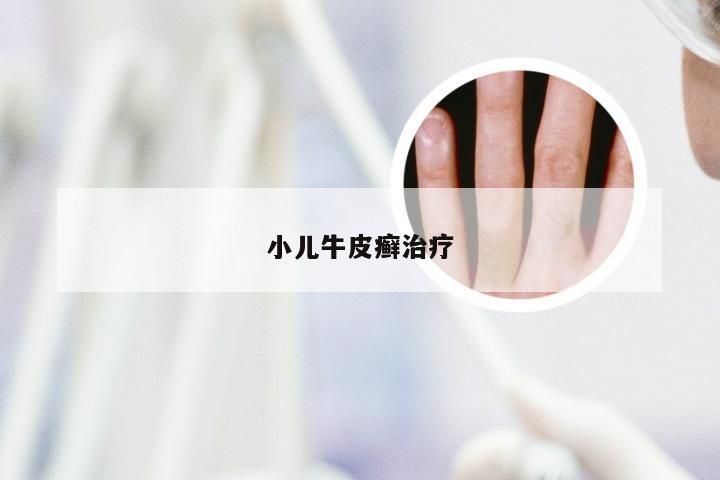 小儿牛皮癣治疗