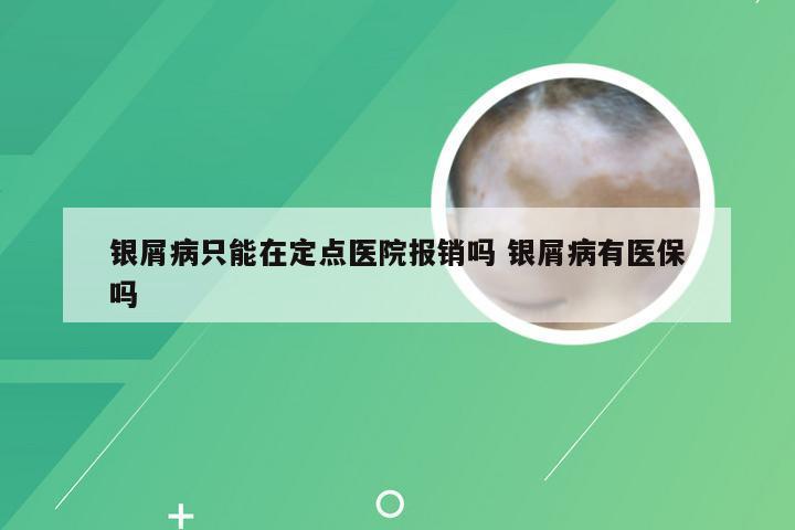 银屑病只能在定点医院报销吗 银屑病有医保吗