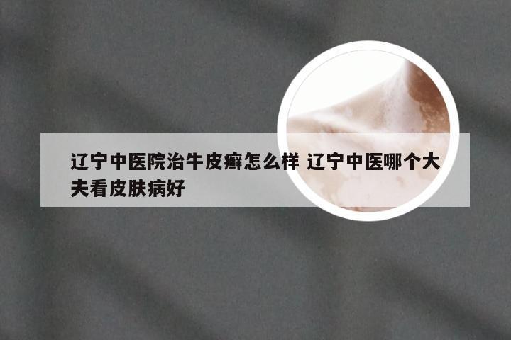 辽宁中医院治牛皮癣怎么样 辽宁中医哪个大夫看皮肤病好