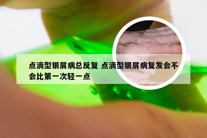 点滴型银屑病总反复 点滴型银屑病复发会不会比第一次轻一点