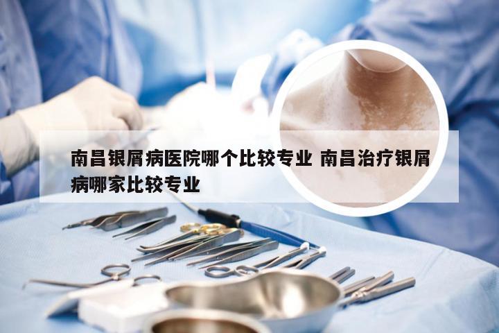 南昌银屑病医院哪个比较专业 南昌治疗银屑病哪家比较专业