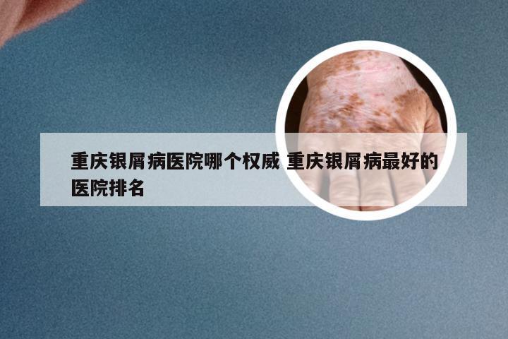 重庆银屑病医院哪个权威 重庆银屑病最好的医院排名