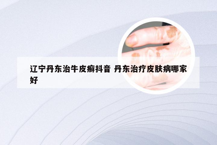 辽宁丹东治牛皮癣抖音 丹东治疗皮肤病哪家好