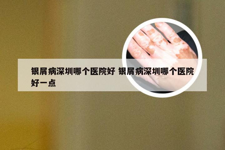 银屑病深圳哪个医院好 银屑病深圳哪个医院好一点
