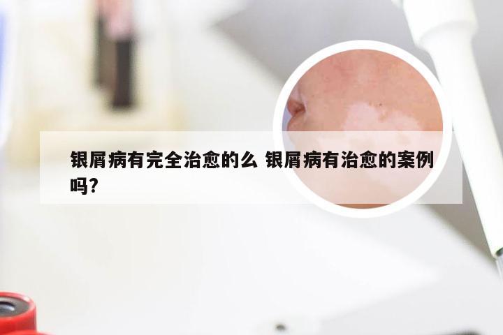 银屑病有完全治愈的么 银屑病有治愈的案例吗?