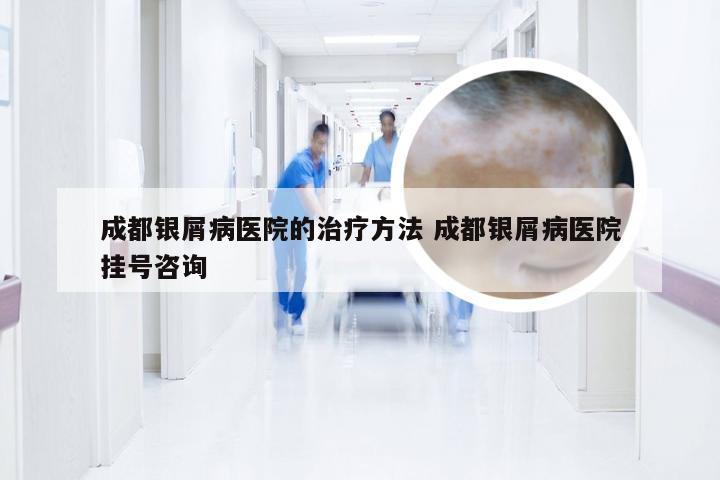 成都银屑病医院的治疗方法 成都银屑病医院挂号咨询