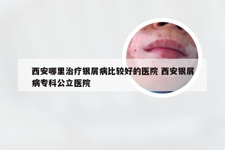 西安哪里治疗银屑病比较好的医院 西安银屑病专科公立医院