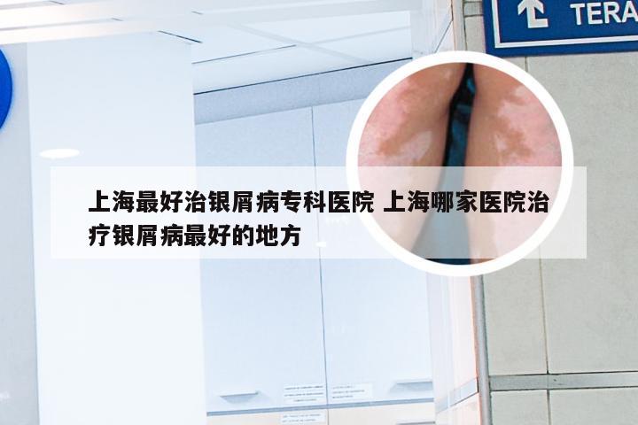 上海最好治银屑病专科医院 上海哪家医院治疗银屑病最好的地方