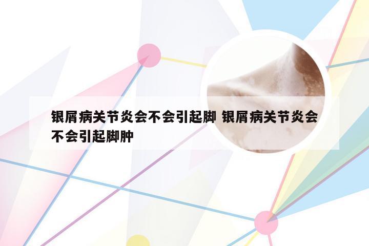银屑病关节炎会不会引起脚 银屑病关节炎会不会引起脚肿