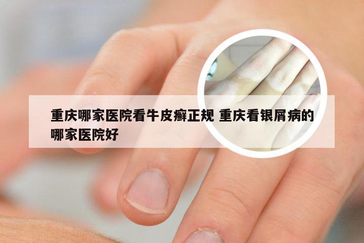 重庆哪家医院看牛皮癣正规 重庆看银屑病的哪家医院好