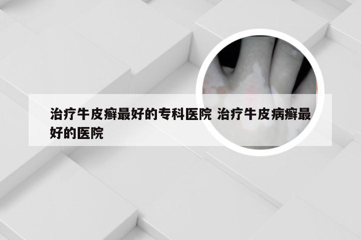 治疗牛皮癣最好的专科医院 治疗牛皮病癣最好的医院