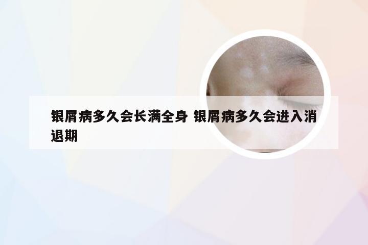 银屑病多久会长满全身 银屑病多久会进入消退期