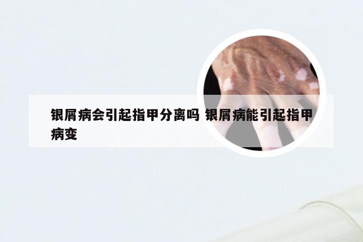银屑病会引起指甲分离吗 银屑病能引起指甲病变