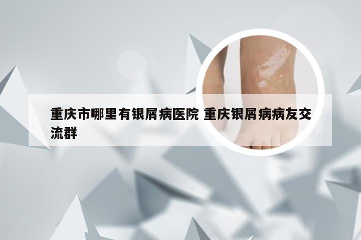 重庆市哪里有银屑病医院 重庆银屑病病友交流群