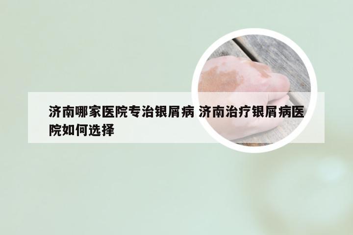 济南哪家医院专治银屑病 济南治疗银屑病医院如何选择